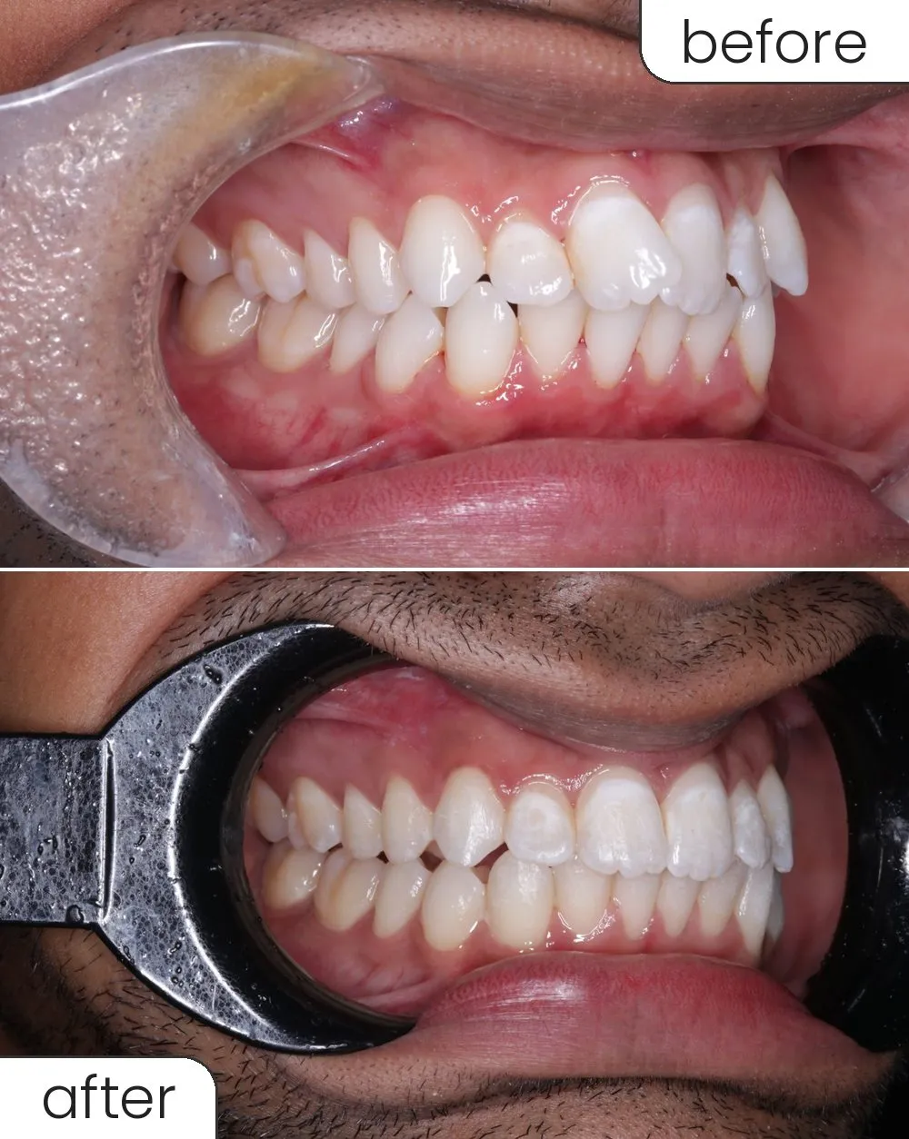 Clear aligner case, side view before and after