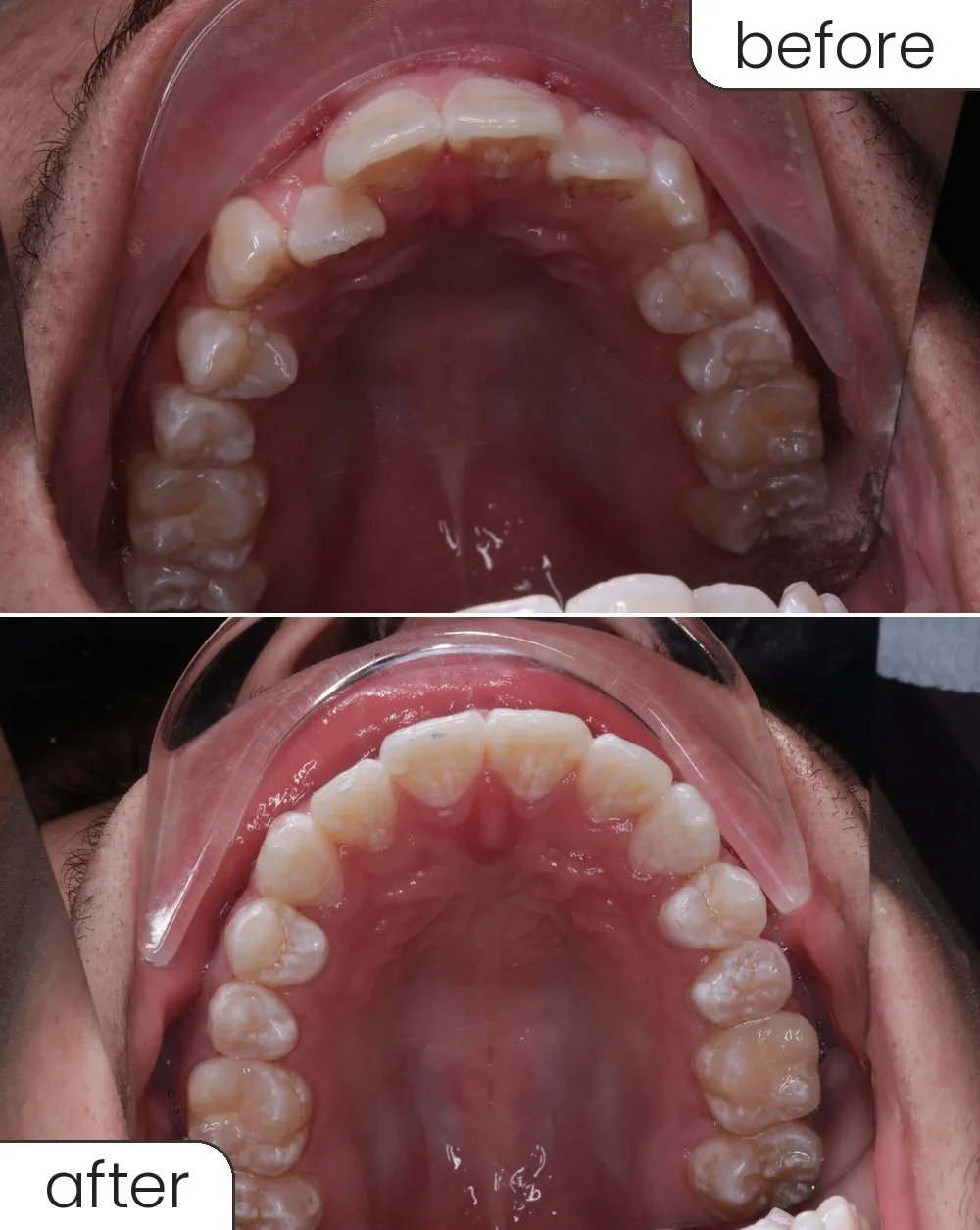 Clear aligner case, upper arch before and after