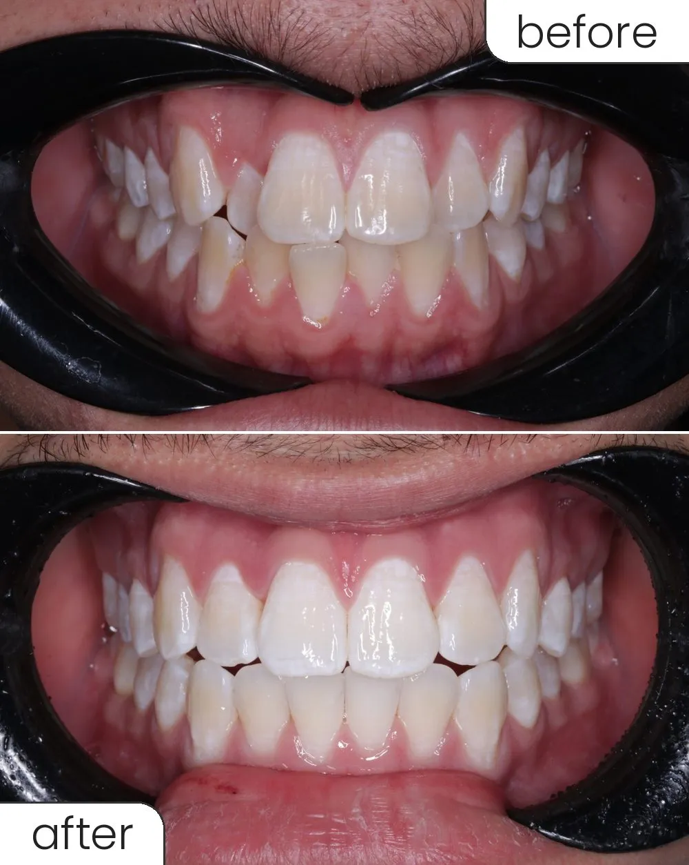 Clear aligner case, front view before and after