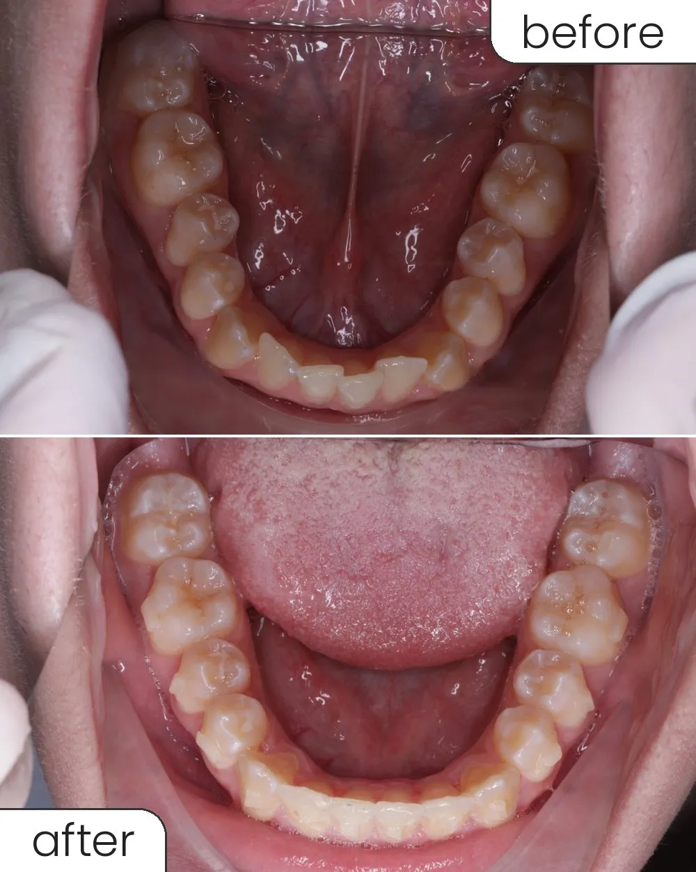Clear aligner case, lower arch before and after