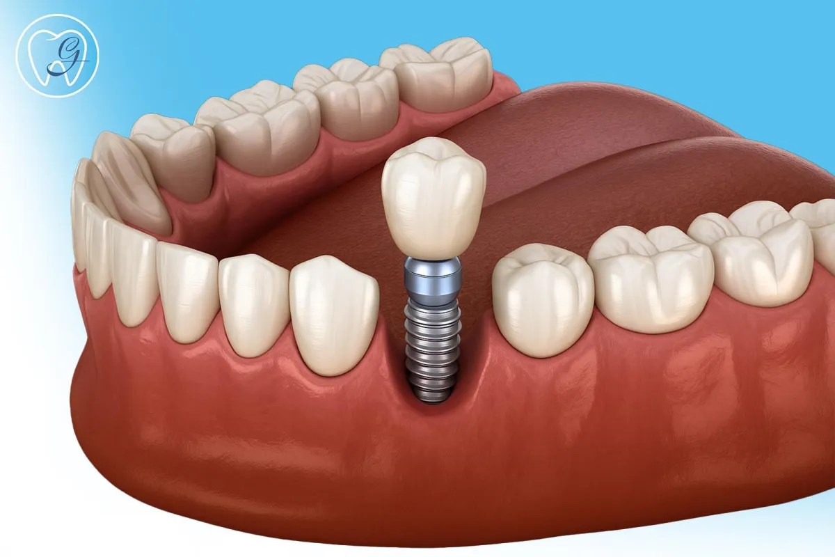 dental impant by gonzalez dental care