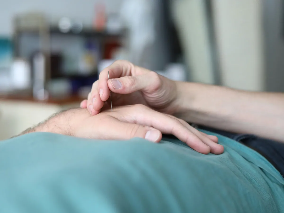 Acupuncture session with needles for wellness and pain relief