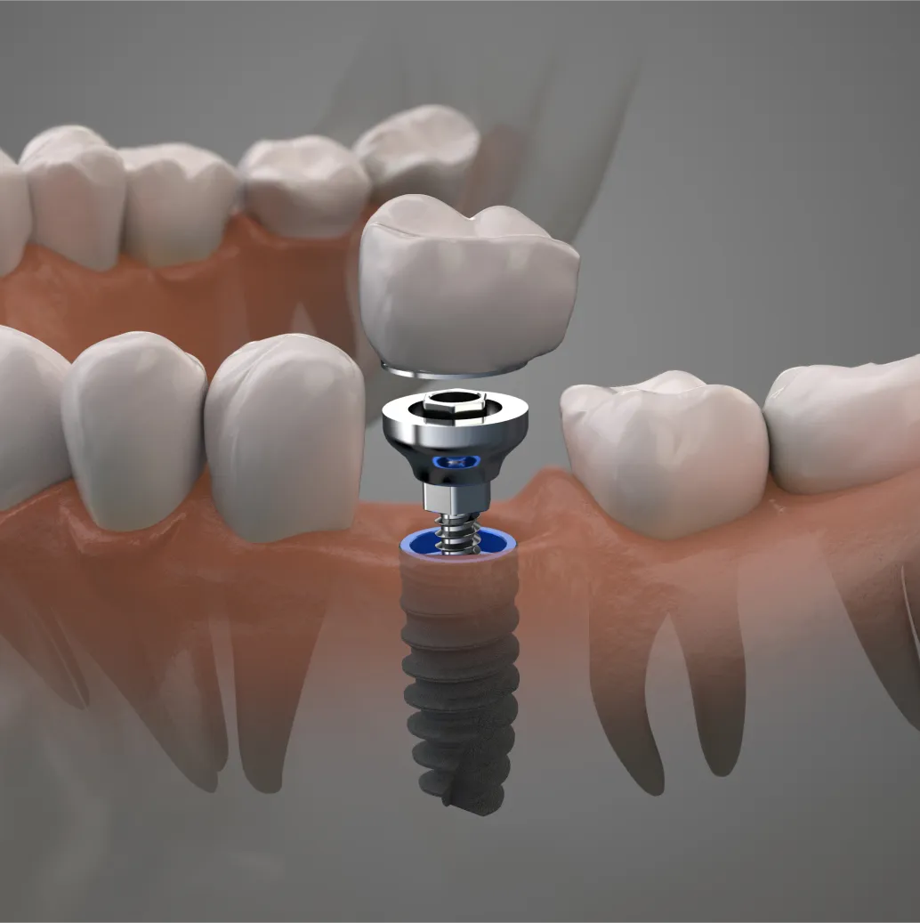 Structure of a dental implant, with a screw embedded into the jaw, threaded to a post insert, which in turn connects to the bottom of the artificial crown