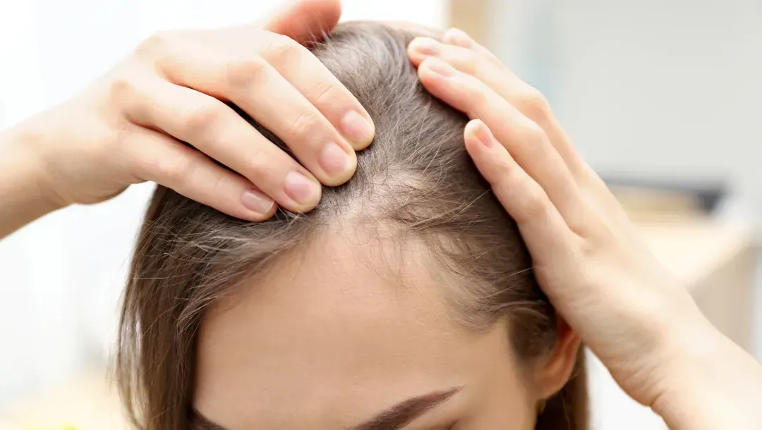 A person parting their hair on the top of their head, revealing a thinning hairline and scalp.