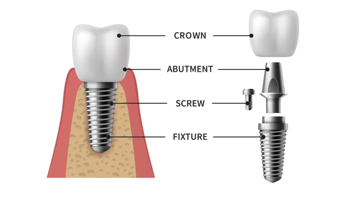 image showing all the parts of a conventional dental implant
