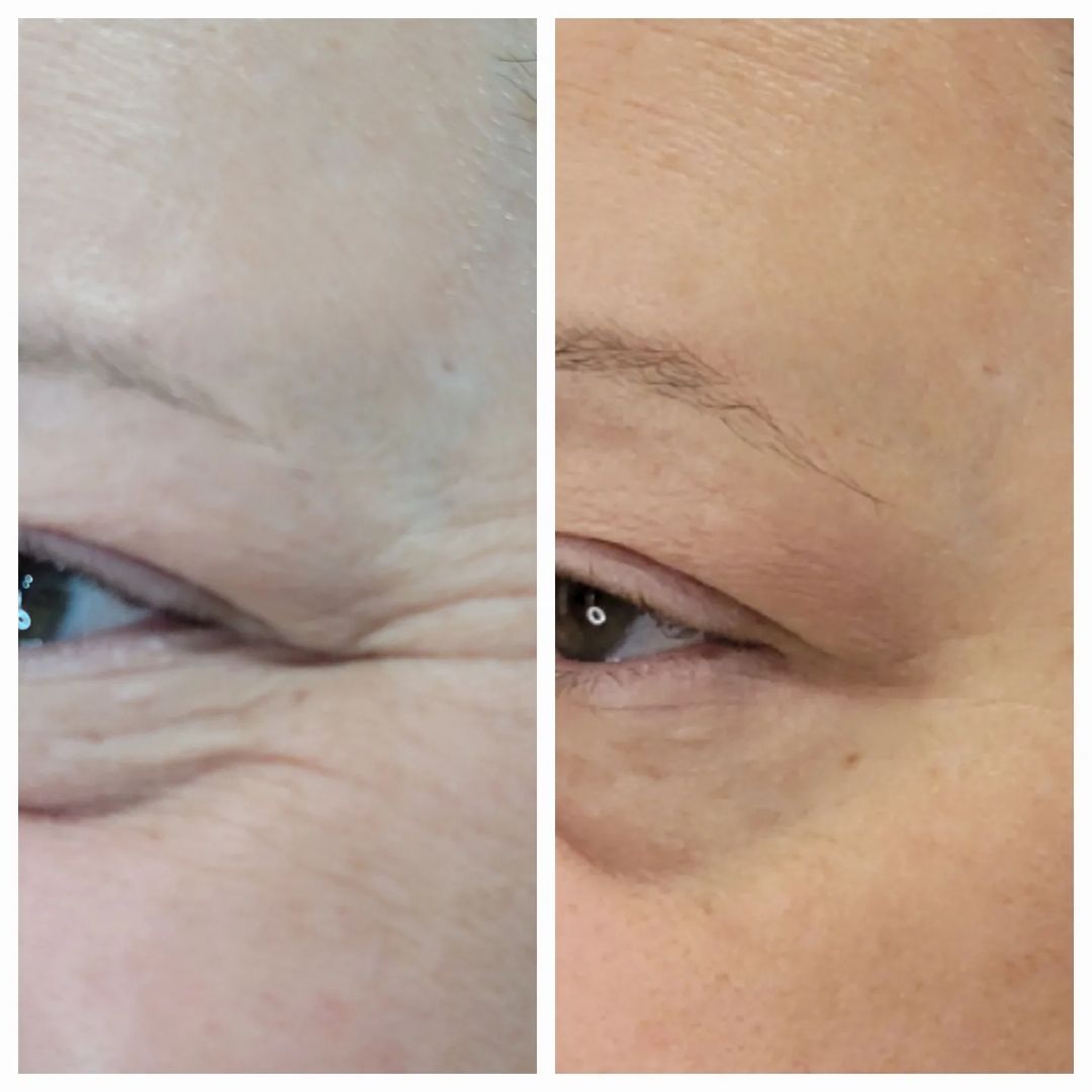 crows feet pampering before and after