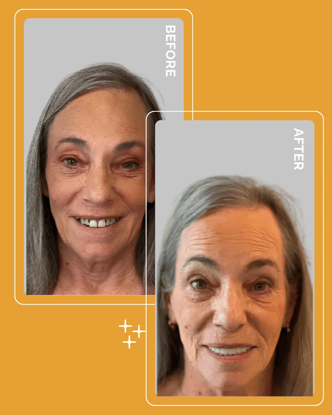 Patient before and after smile transformation