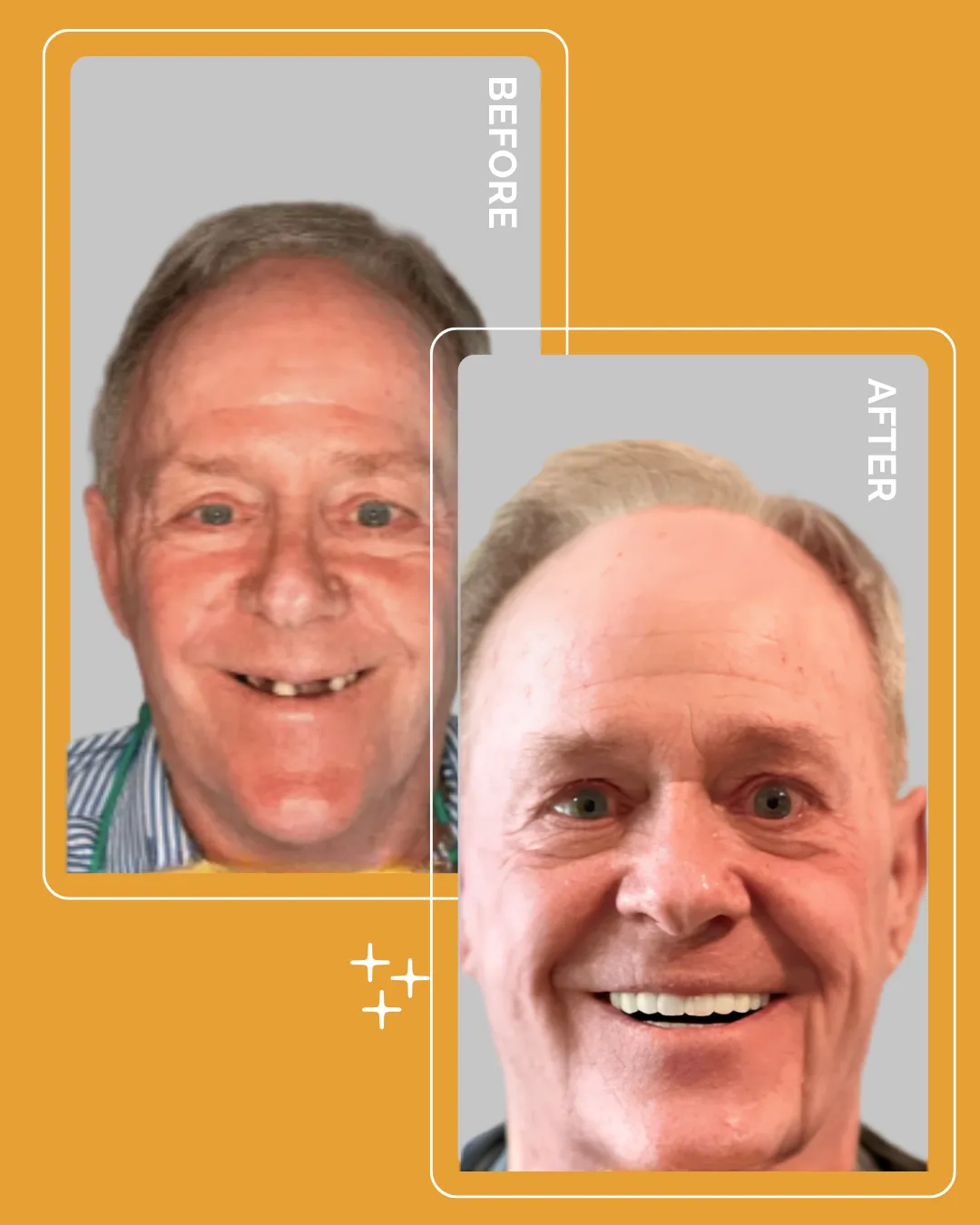 Patient before and after smile transformation