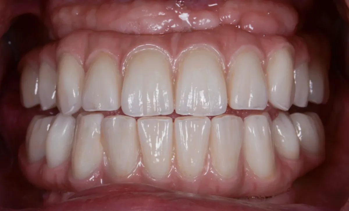 Permanent Fixed Full Arch