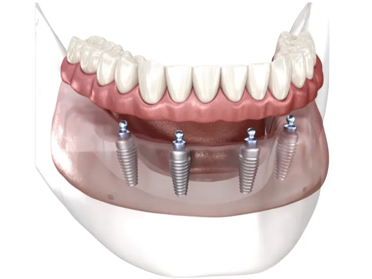 Implant Retained Snap-On Denture