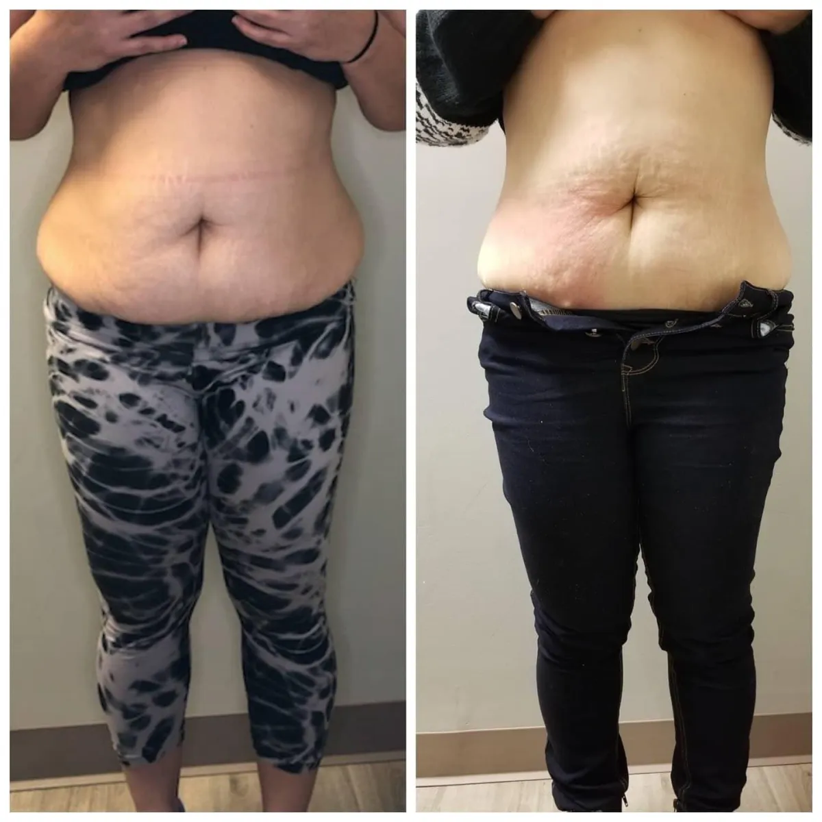 before and after red light therapy woman