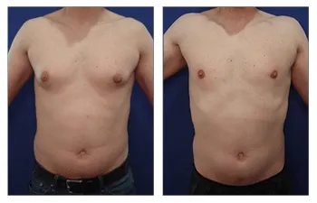 Before and after gynecomastia treatment – male chest transformation from excess tissue to a sculpted appearance.