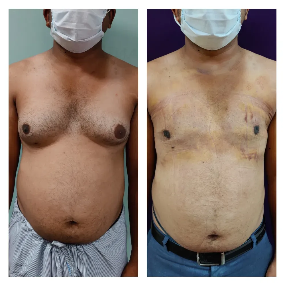 Before and after gynecomastia treatment – male chest transformation from excess tissue to a sculpted appearance.