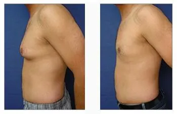Before and after gynecomastia treatment – male chest transformation from excess tissue to a sculpted appearance.