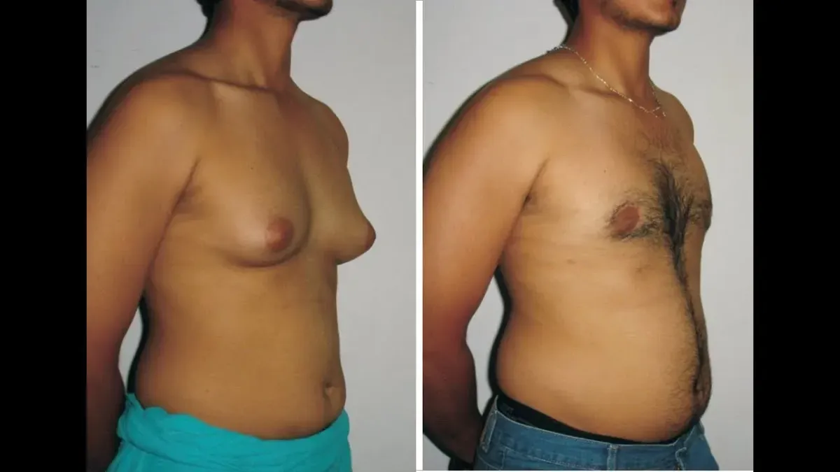 Before and after gynecomastia treatment – male chest transformation from excess tissue to a sculpted appearance.