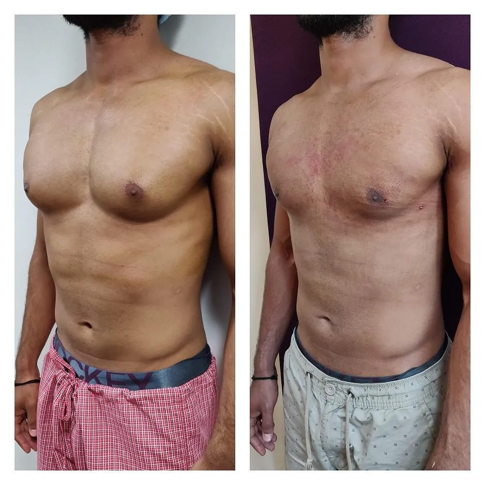 Before and after gynecomastia treatment – male chest transformation from excess tissue to a sculpted appearance.