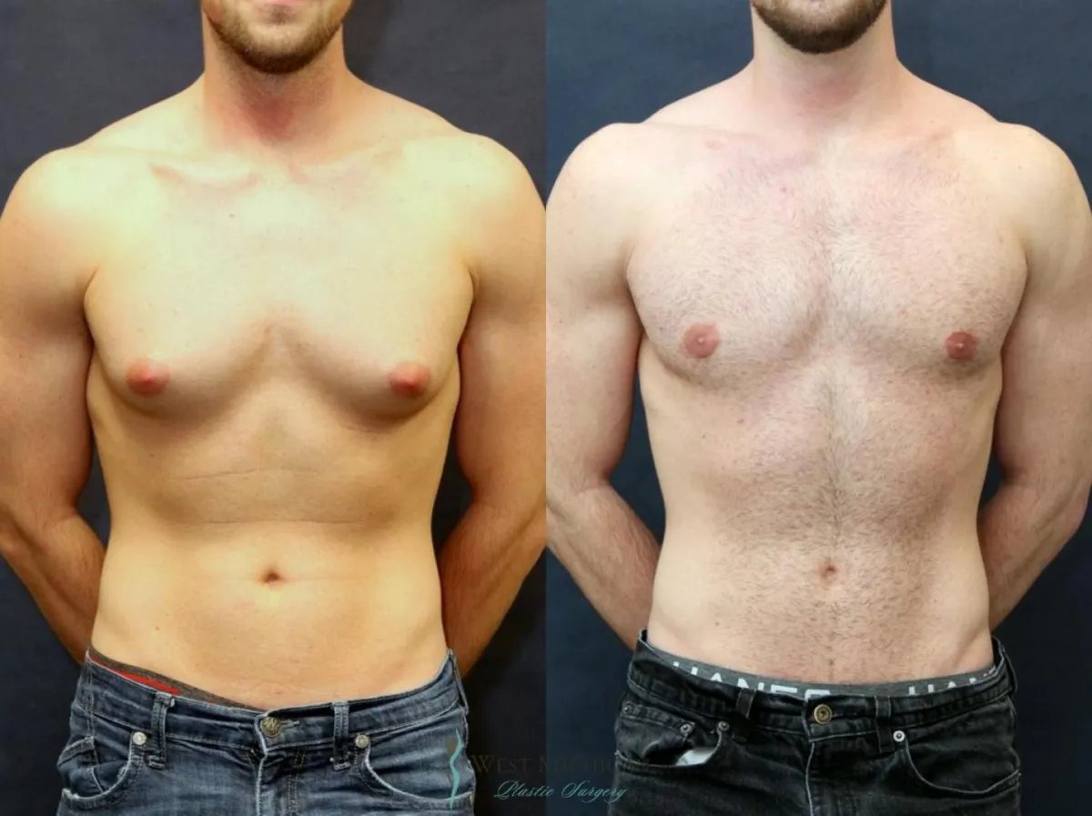 Before and after gynecomastia treatment – male chest transformation from excess tissue to a sculpted appearance.