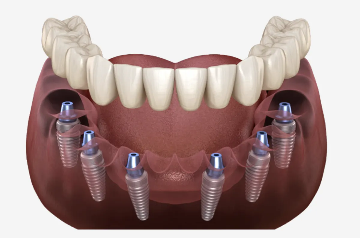dentist that does implants near me
