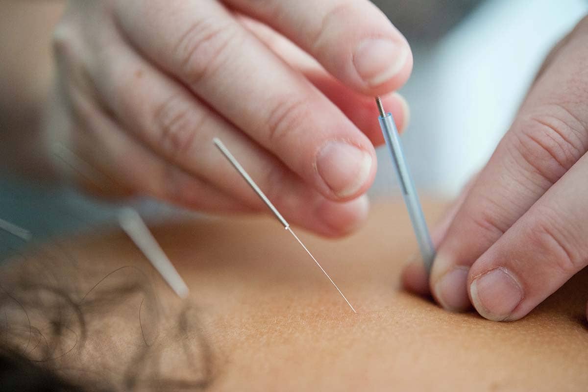 A close-up shot of an acupuncture session with a professional practitioner inserting fine needles into a patient's back for pain relief and immune support.
