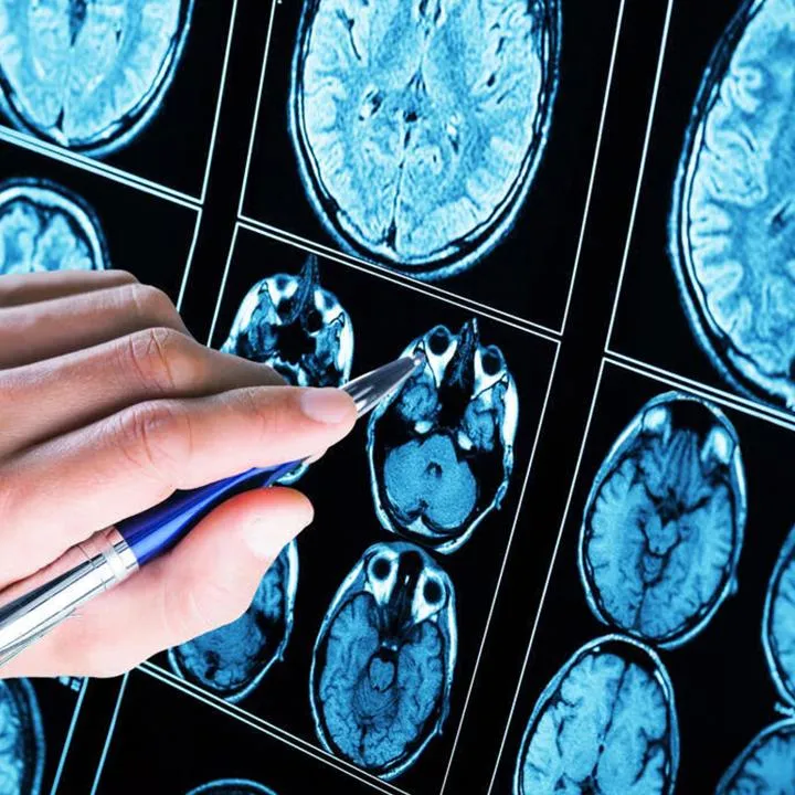 A neurologist in Hagerstown & Cumberland, MD, explaining the latest innovations in epilepsy treatment, including advanced therapies and research.