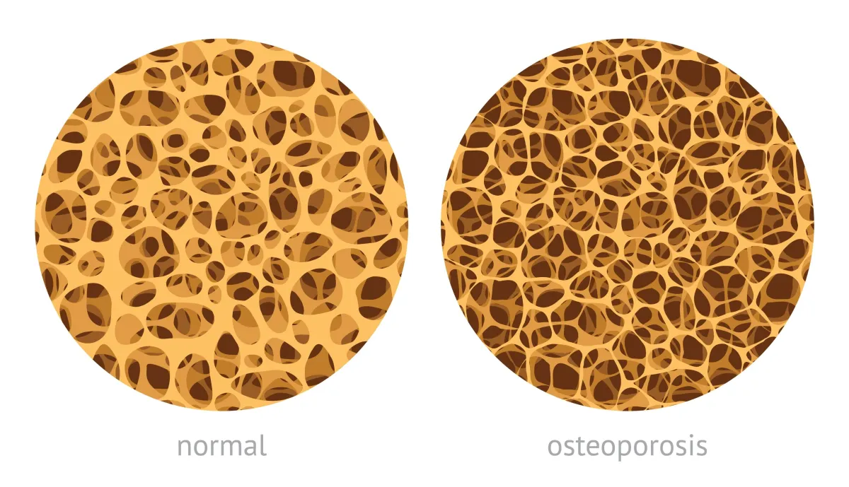 The Osteoporosis Advice That Makes Bones Weaker