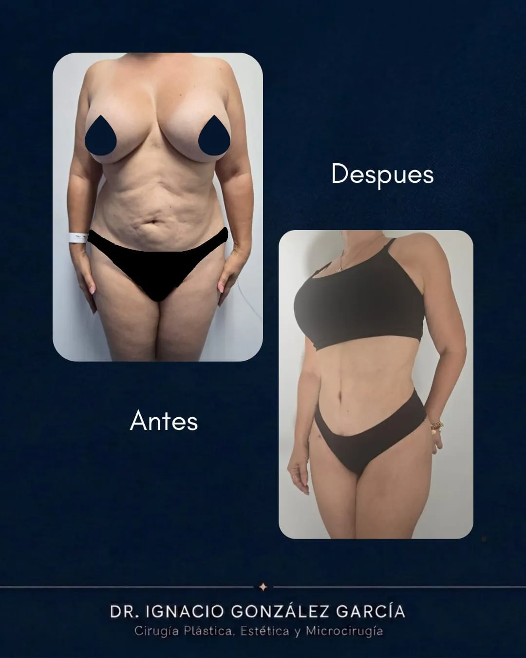 Caso clínico antes y después de Mommy Makeover por el Dr. Ignacio González García