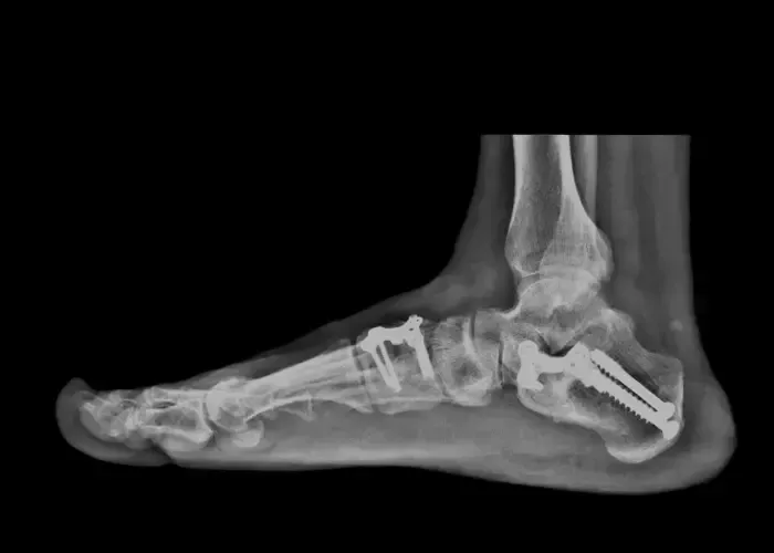 Foot X-ray with surgical hardware demonstrating structural alignment and correction for severe fallen arches.