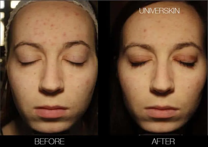 Before and After picture of a woman's face showing the positive results of Universkin