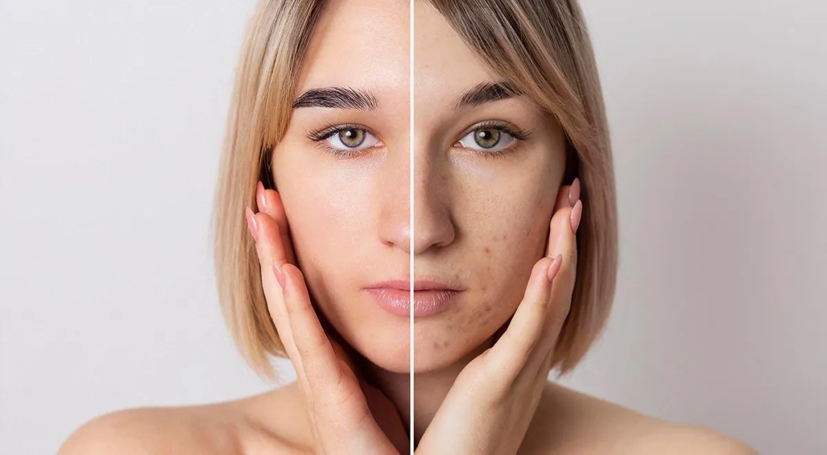 Split view of a face with one side suffering from Hyperpigmentation and other one clear.