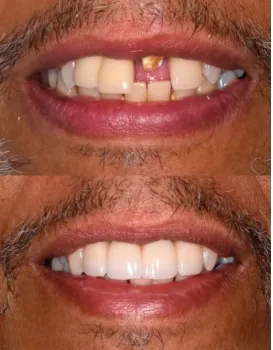Smile Makeovers