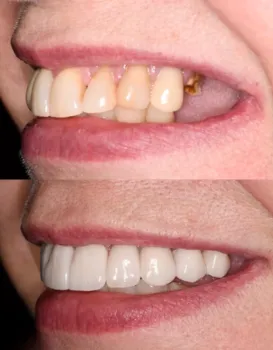 Permanent Implants