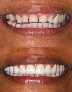 Smile Makeovers