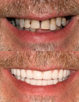 Snap on Dentures