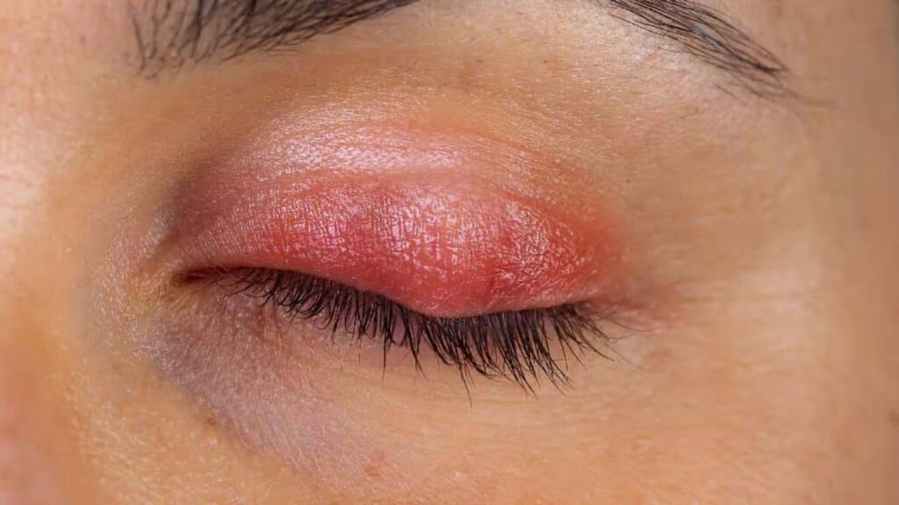 Orzuelo y Chalazión: Bolitas en el Párpado que Molestan