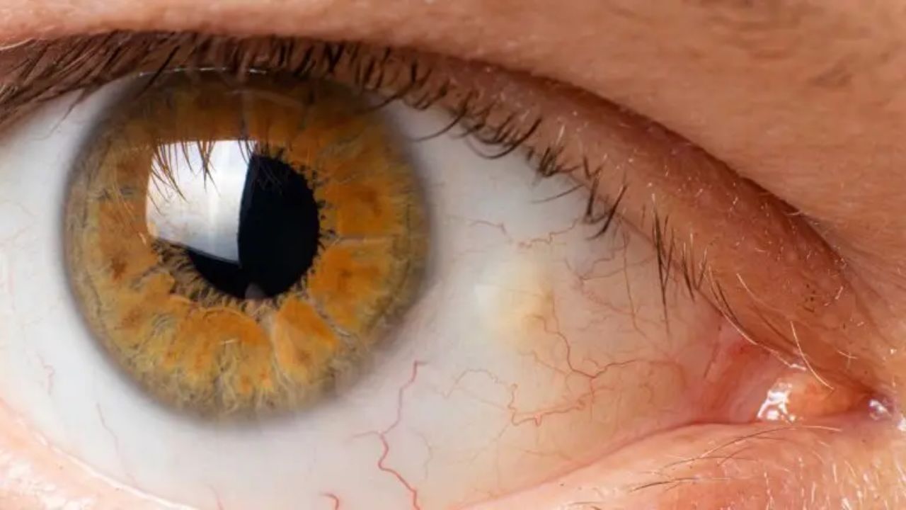 Pingüécula: La Mancha Amarilla en el Ojo que Preocupa a Muchos