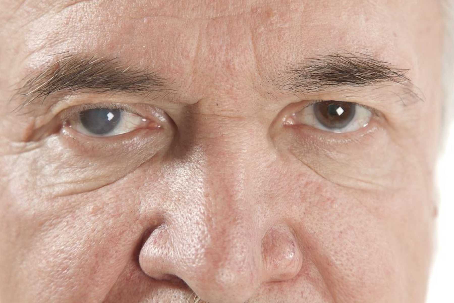 Paciente antes y después de cirugía refractiva sin lentes