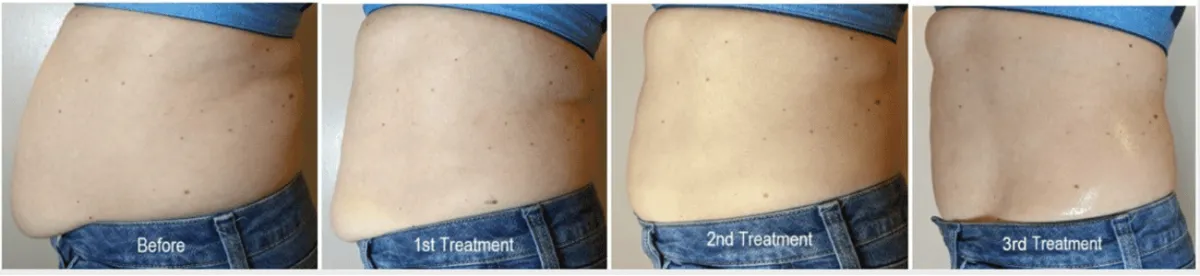 Beyond Body Sculpting body contouring abdomen