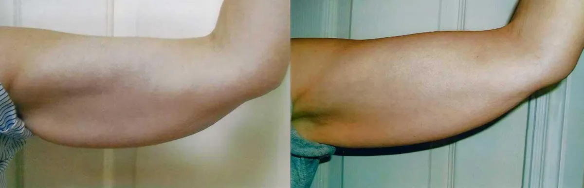 Beyond Body Sculpting body contouring arms