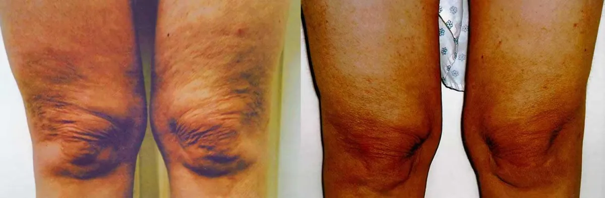 Beyond Body Sculpting body contouring knees, legs, and bottom