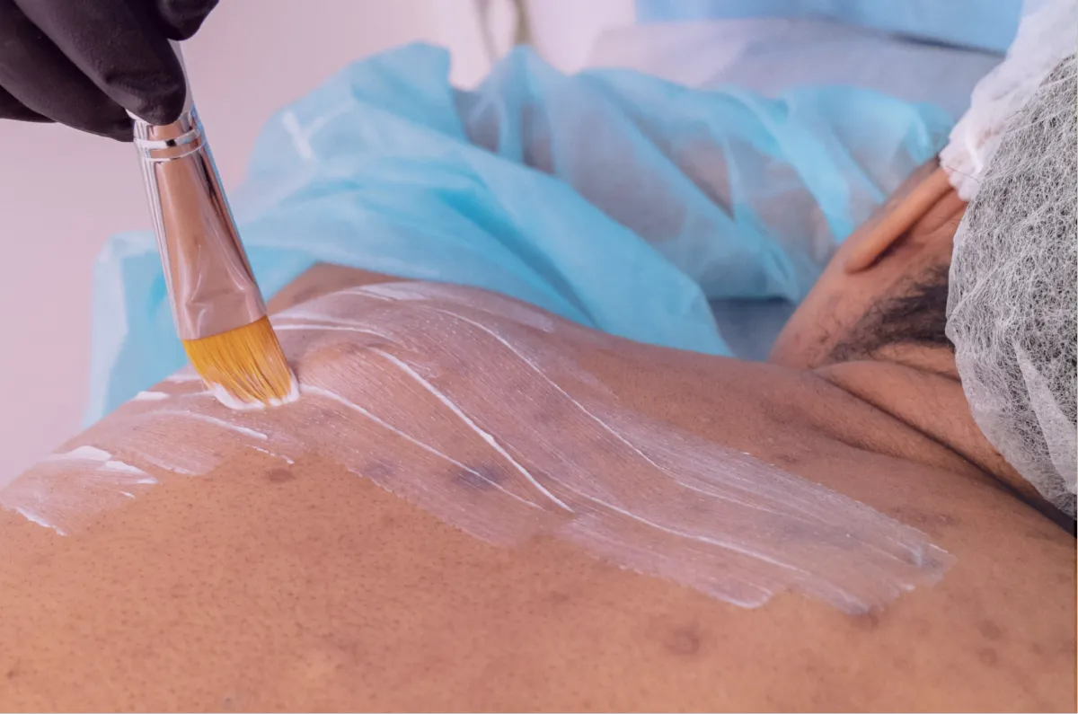 Therapeutic back acne treatment featuring deep pore cleansing and exfoliation