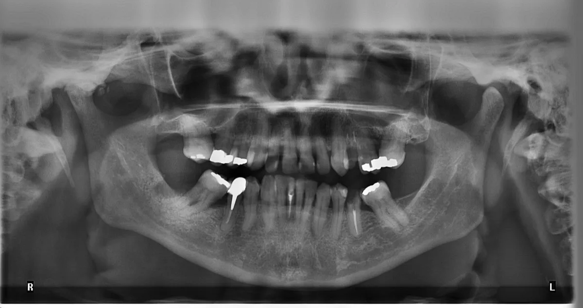 emergency-wisdom-tooth