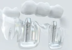 Zirconia full arch implant bridge close-up high detail