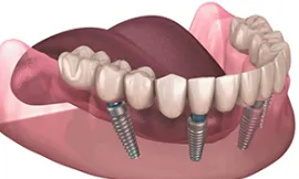 Zirconia full arch implant bridge close-up high detail