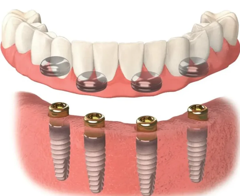 Zirconia full arch implant bridge close-up high detail
