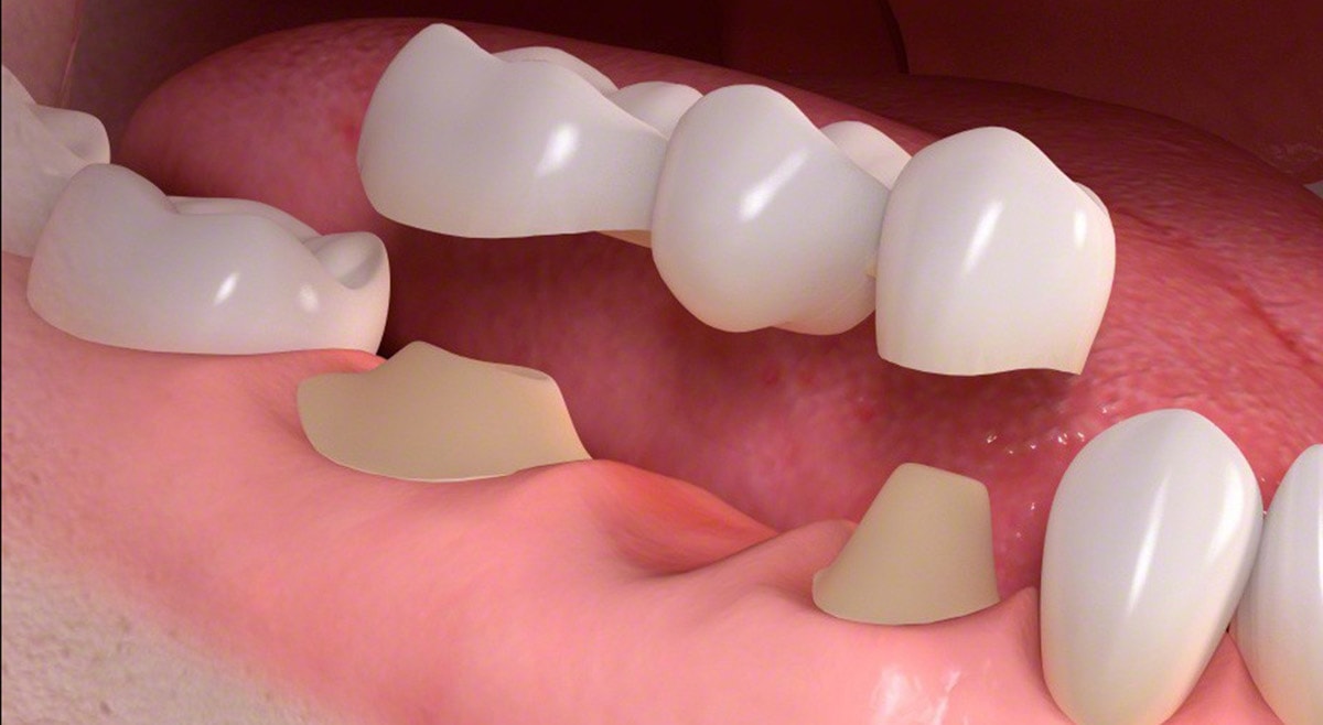 Zirconia full arch implant bridge close-up high detail