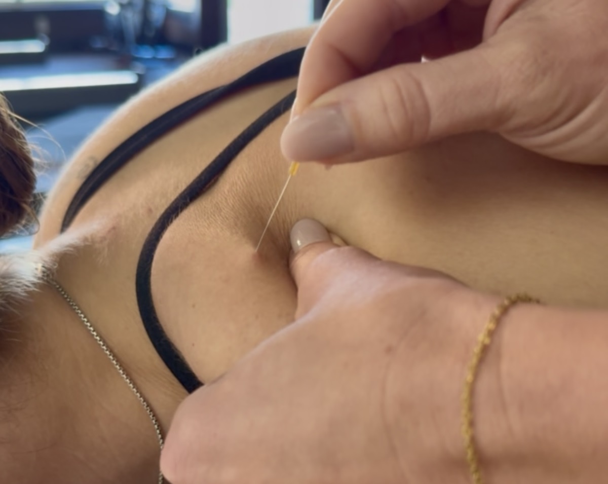 Close up of dry needling on lower back. 