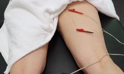 The Benefits of Dry Needling for Muscle and Joint Injuries