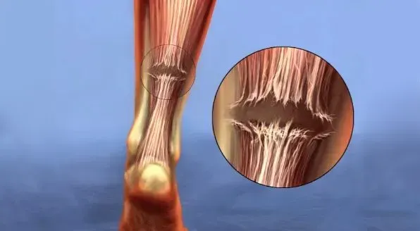 Achilles tendon, achilles tear, achilles pain