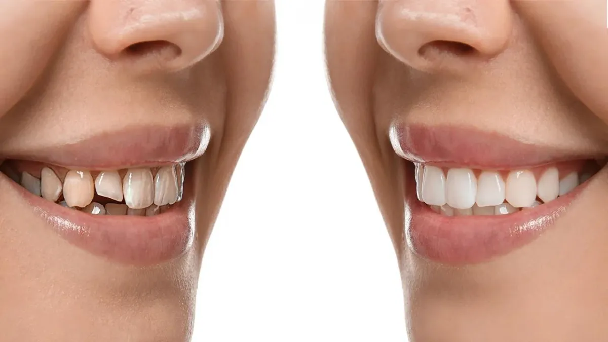 Side-by-side comparison of a smile with uneven teeth and one with aligned, whitened teeth