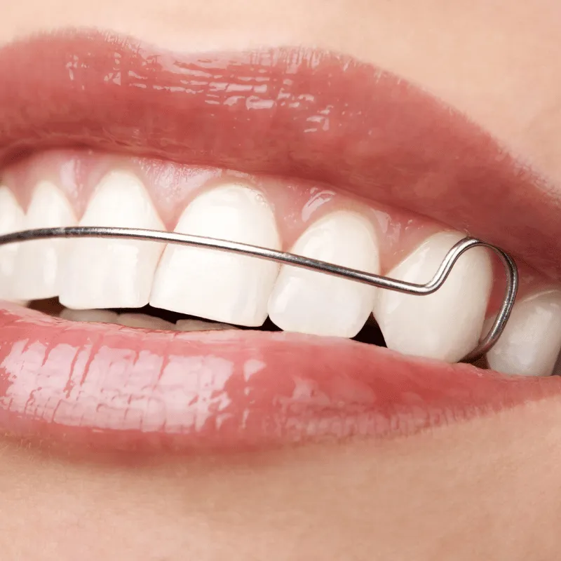 Close-up of a woman's smile revealing bright white teeth with a metal dental retainer positioned across them.